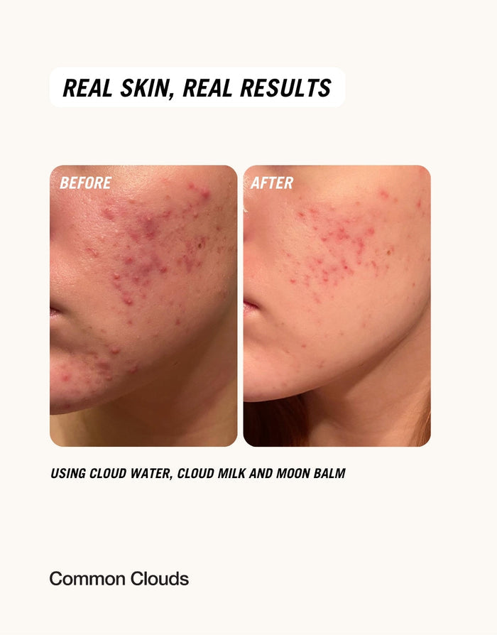 POST-BLEMISH HEROES