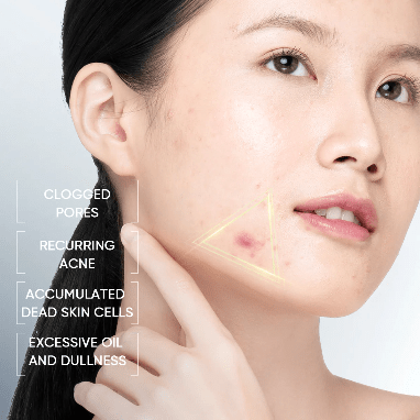 Skintific 3X Acid Anti - Acne Gel Moisturizer 30g. سكينتفيك 3X حمض مضاد لحب الشباب جل مرطب - Princess Cosmetics Qatar