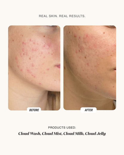 Before and after comparison of a person's cheek showing acne and redness improvement, with text reading 'REAL SKIN. REAL RESULTS.